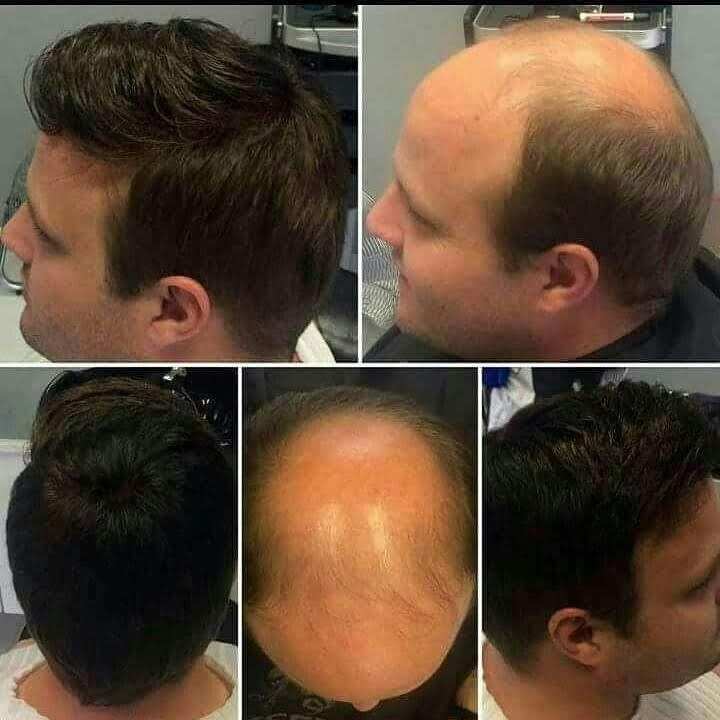 Before and after hair patch transformations